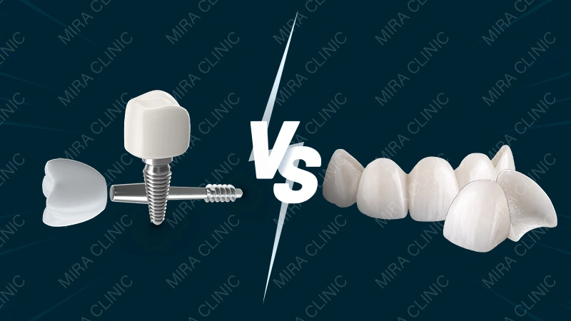 Veneers vs Crowns